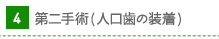 第二手術(人口歯の装着)